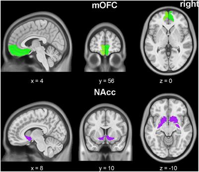 Decreased Connection Between Reward Systems and Paralimbic Cortex in Depressive Patients